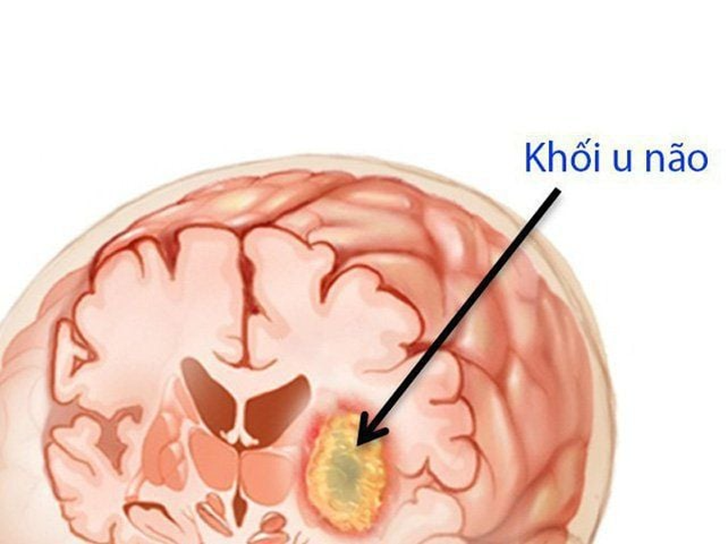 dot-nhien-dung-hinh-di-kham-phat-hien-u-nao-lon