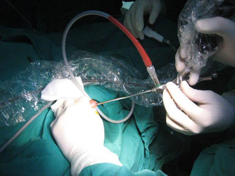 phau-thuat-tiet-nieu-tre-em-nhieu-thach-thuc