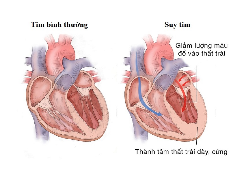 phu-chan-kho-tho-moi-biet-minh-suy-tim