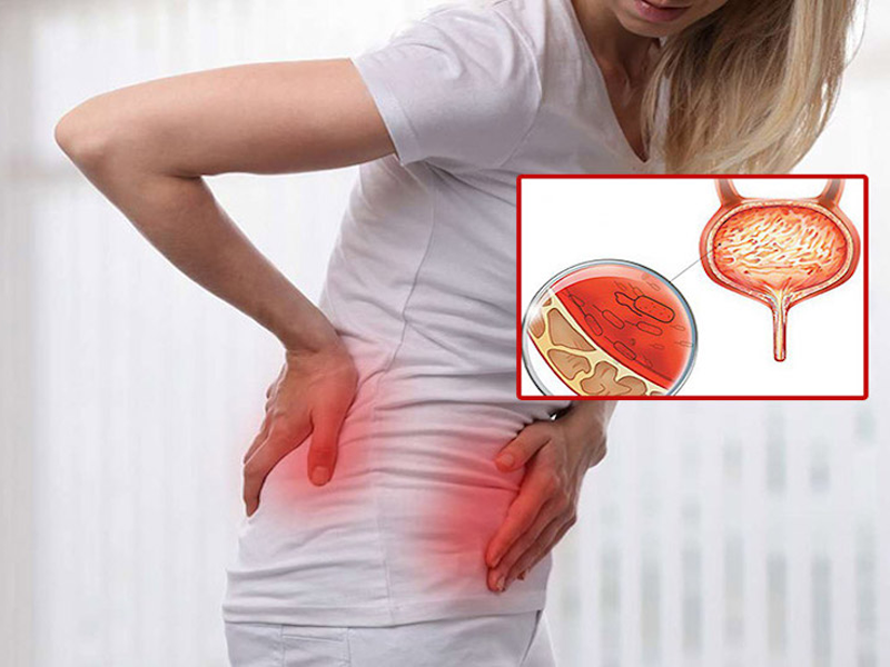 phu-nu-bi-viem-bang-quang-ke-nhieu-hon-nam-gioi