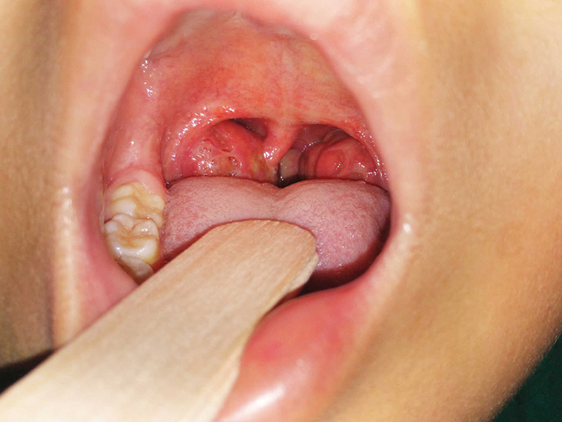 u-nang-vom-hong-khien-nguoi-dan-ong-viem-mui-keo-dai
