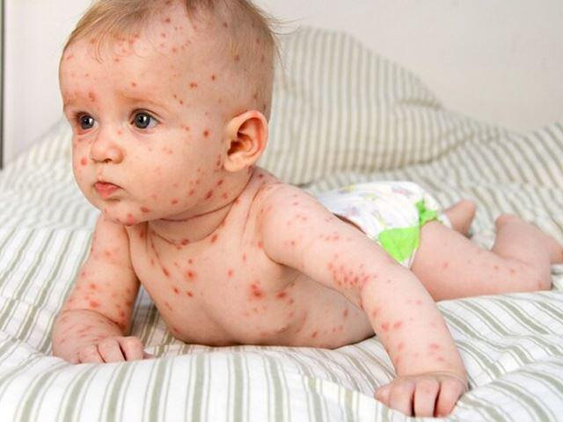 benh-soi-o-tre-em-nhung-dieu-phu-huynh-can-biet-de-bao-ve-con-yeu-khoi-can-benh-nguy-hiem